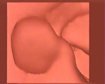 VC reconstruction of a colonic polyp